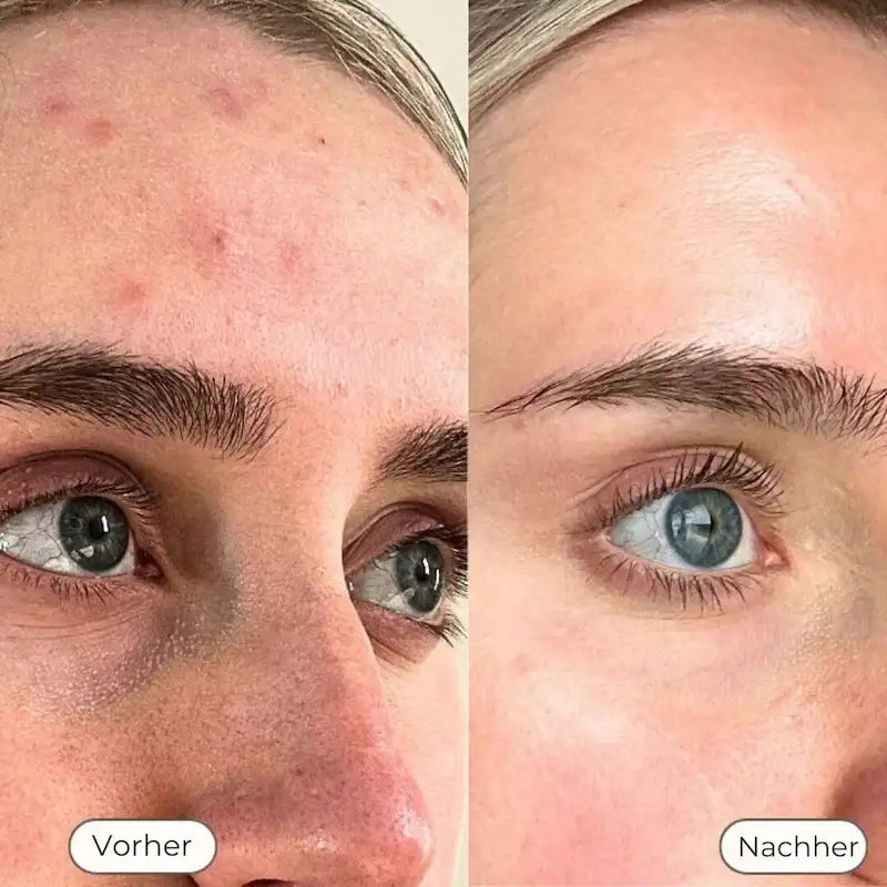 NAVAÉ PhotonSkin™ LED Maske