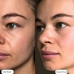 NAVAÉ PhotonSkin™ LED Maske